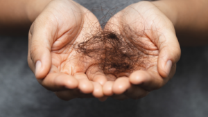 Revolução no Transplante Capilar: CryoFólic e ND2 prometem densidade e naturalidade inéditas com criogenia