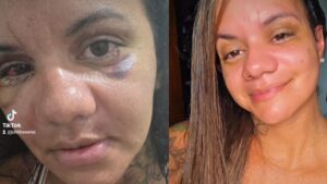 Após brutal ataque com 61 socos, influenciadora revela face reconstruída